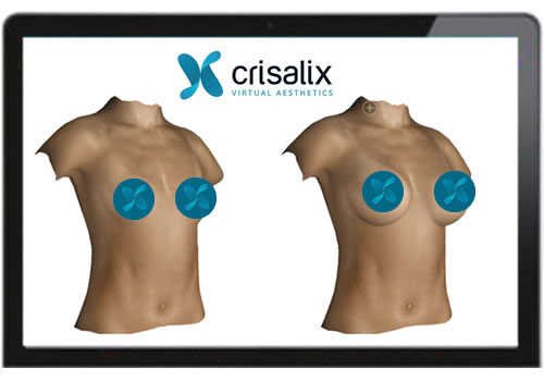 Can Breast Augmentation Fix Saggy Breasts? - Criswell & Criswell Plastic  Surgery